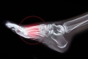 Illustration fracture de fatigue au pied